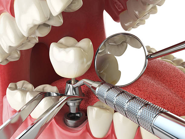 Best Emergency Wisdom Teeth Removal in Penryn, CA